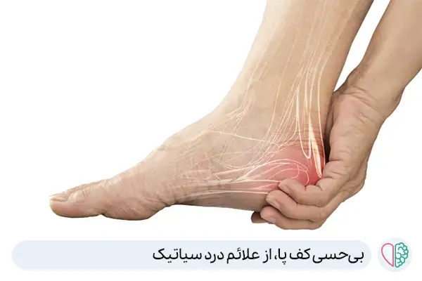 بی‌حسی کف پا علامت درد سیاتیک|آگاه طب
