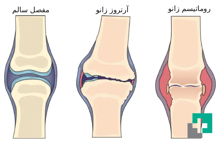 انواع درد زانو