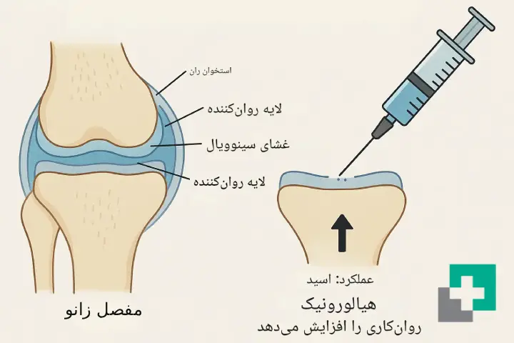 تزریق هیالورونیک اسید