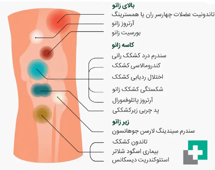 علت بروز زانو درد در نقاط مختلف