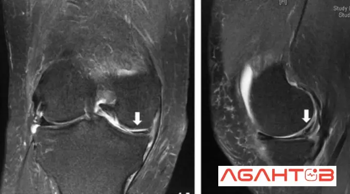 تشخیص آسیب مینیسک زانو (1)