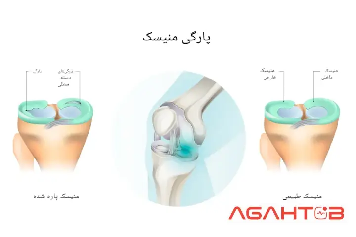 مینیسک و آسیب های آن