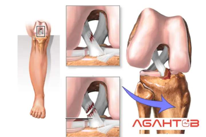 آسیب رباط صلیبی قدامی