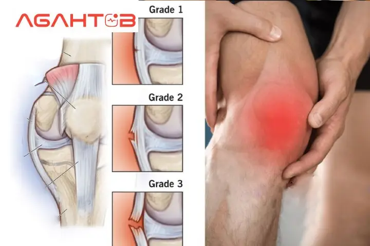 تفاوت پارگی و کشیدگی رباط زانو