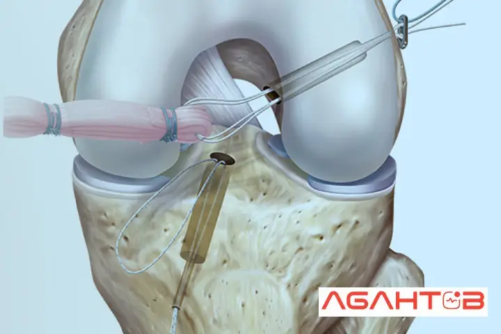 جراحی آسیب رباط صلیبی قدامی