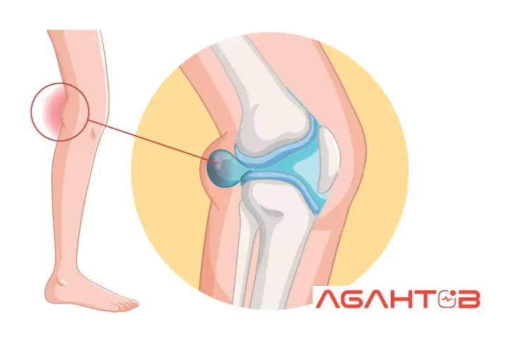 ورم زانو به علت کیست بیکر